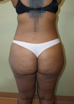 Before Image: Brazilian Butt Lift - back