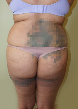 Before Image: Brazilian Butt Lift - back