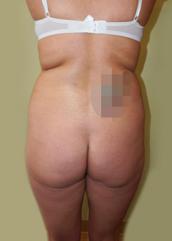 Before Image: Brazilian Butt Lift - back
