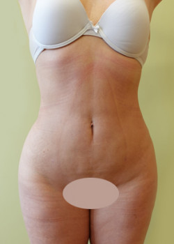 After Image: Liposuction - front