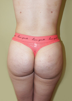 After Image: Brazilian Butt Lift - back