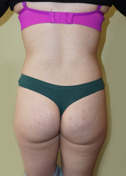 Before Image: Brazilian Butt Lift - back