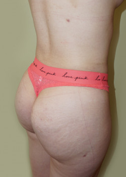 After Image: Brazilian Butt Lift - right-front-oblique