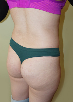 Before Image: Brazilian Butt Lift - right-front-oblique