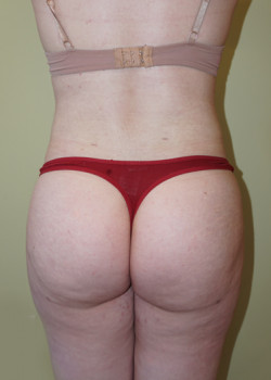 After Image: Brazilian Butt Lift - back