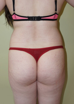 Before Image: Brazilian Butt Lift - back