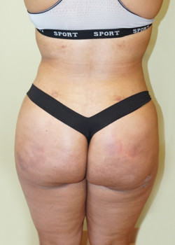 After Image: Brazilian Butt Lift - back