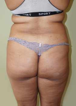 Before Image: Brazilian Butt Lift - back