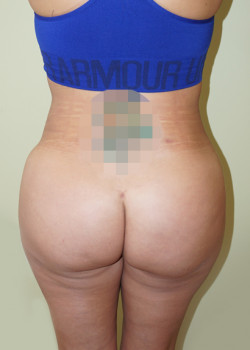 After Image: Brazilian Butt Lift - back