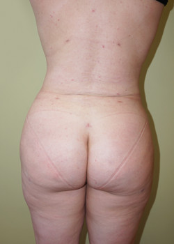 After Image: Brazilian Butt Lift - back
