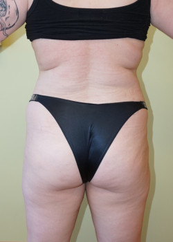 Before Image: Brazilian Butt Lift - back