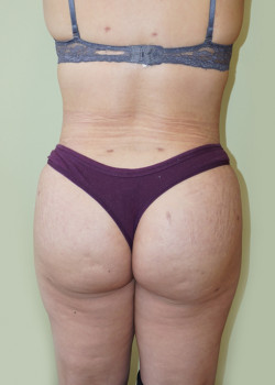 After Image: Brazilian Butt Lift - back