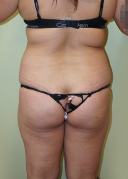 Before Image: Brazilian Butt Lift - back