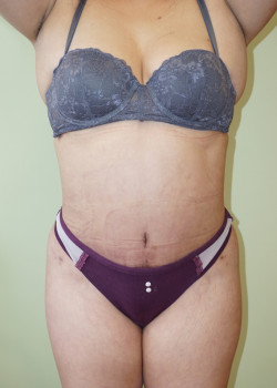 After Image: Tummy Tuck, Liposuction - front