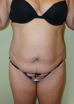 Before Image: Tummy Tuck, Liposuction - front