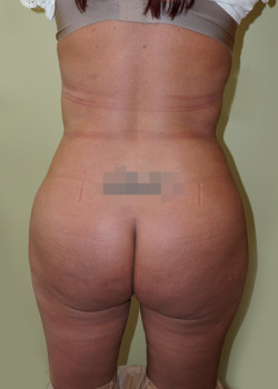After Image: Brazilian Butt Lift - back
