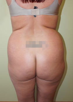 Before Image: Brazilian Butt Lift - back
