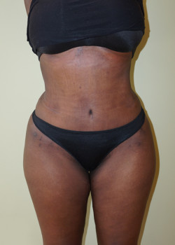 After Image: Tummy Tuck, Liposuction - front