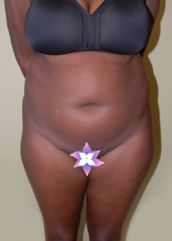 Before Image: Tummy Tuck, Liposuction - front
