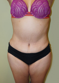 After Image: Tummy Tuck, Liposuction - front