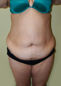 Before Image: Tummy Tuck, Liposuction - front