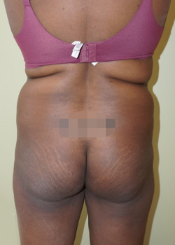 Before Image: Brazilian Butt Lift - front