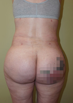After Image: Brazilian Butt Lift - back