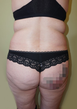 Before Image: Brazilian Butt Lift - back