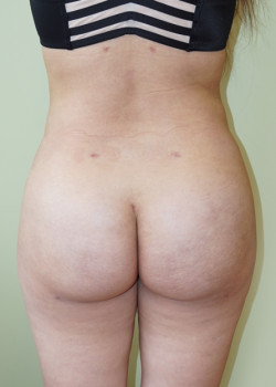 After Image: Brazilian Butt Lift - back