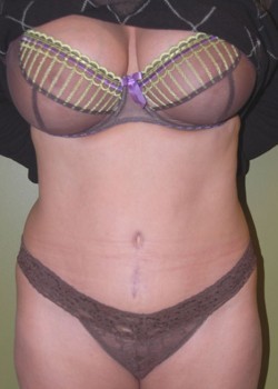 After Image: Tummy Tuck w/ Liposuction - front
