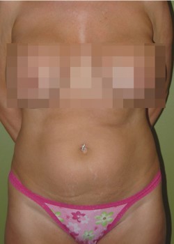 Before Image: Tummy Tuck w/ Liposuction - front
