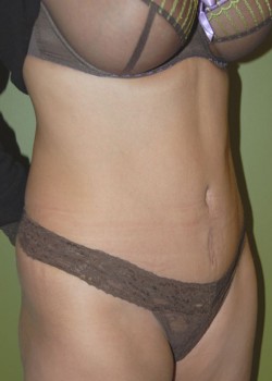 After Image: Tummy Tuck w/ Liposuction - right-front-oblique