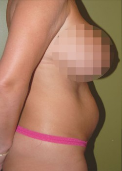 Before Image: Tummy Tuck w/ Liposuction - other