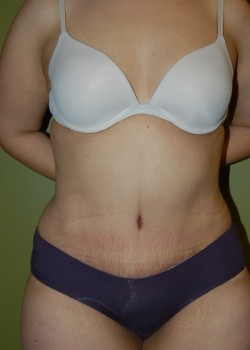 After Image: Tummy Tuck w/ Liposuction - front