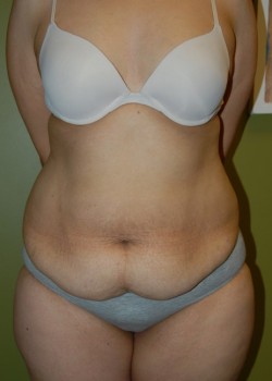Before Image: Tummy Tuck w/ Liposuction - front