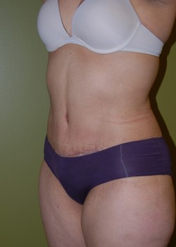 After Image: Tummy Tuck w/ Liposuction - left-front-oblique