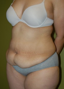 Before Image: Tummy Tuck w/ Liposuction - left-front-oblique