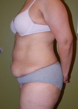 Before Image: Tummy Tuck w/ Liposuction - other