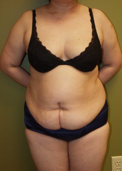Before Image: Tummy Tuck w/ Liposuction - front