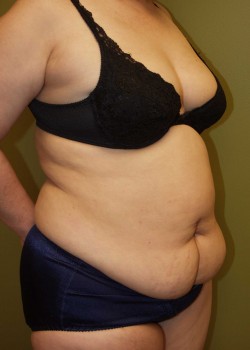 Before Image: Tummy Tuck w/ Liposuction - right-front-oblique