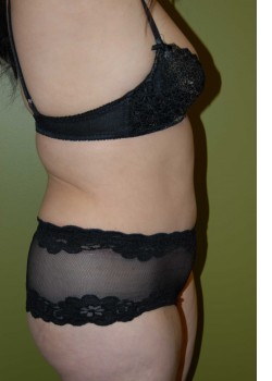 After Image: Tummy Tuck w/ Liposuction - other