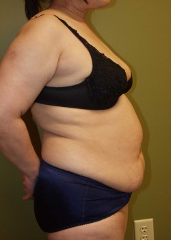 Before Image: Tummy Tuck w/ Liposuction - other